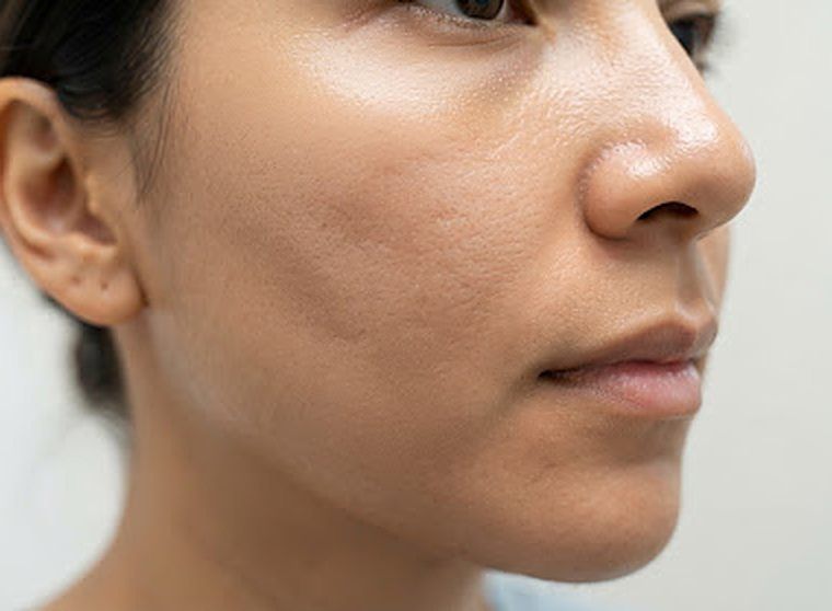 Smoother cheek, after