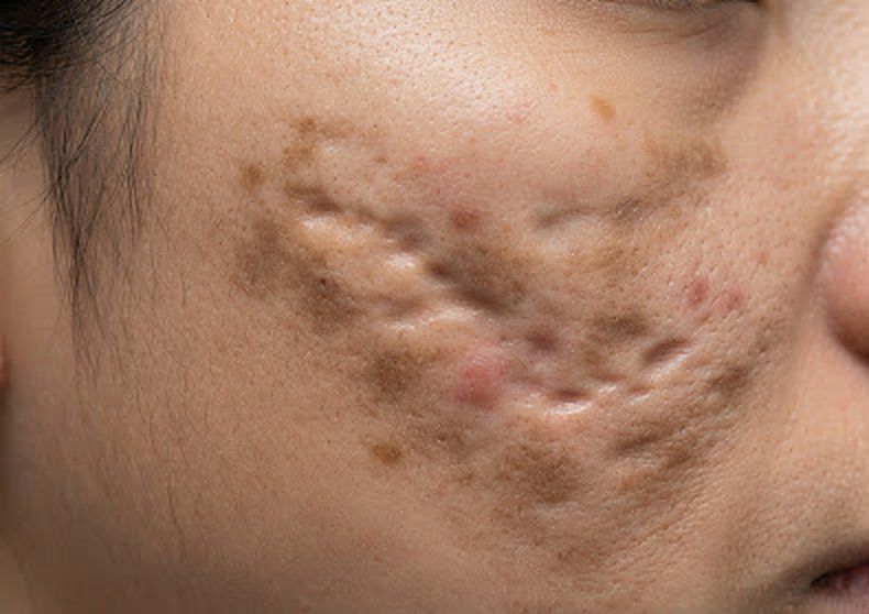 Cheek with acne scars, before