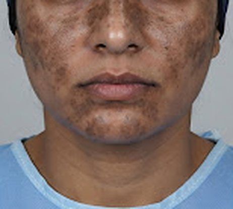 Cheeks with melasma, before