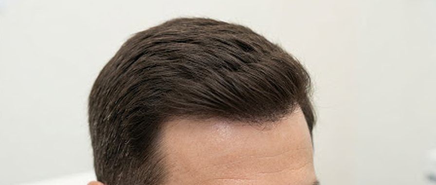 Fuller hair, after