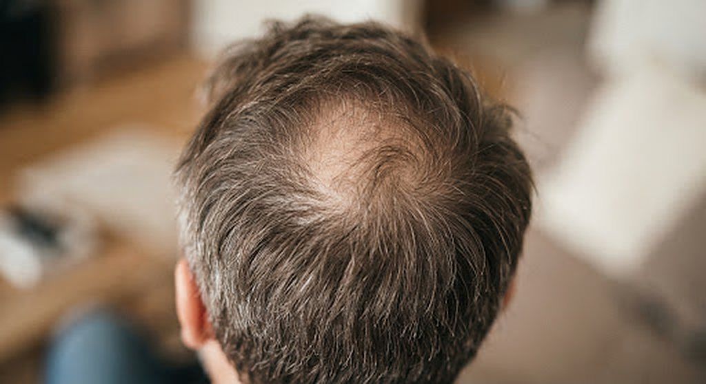 Thinning hair at the crown, before