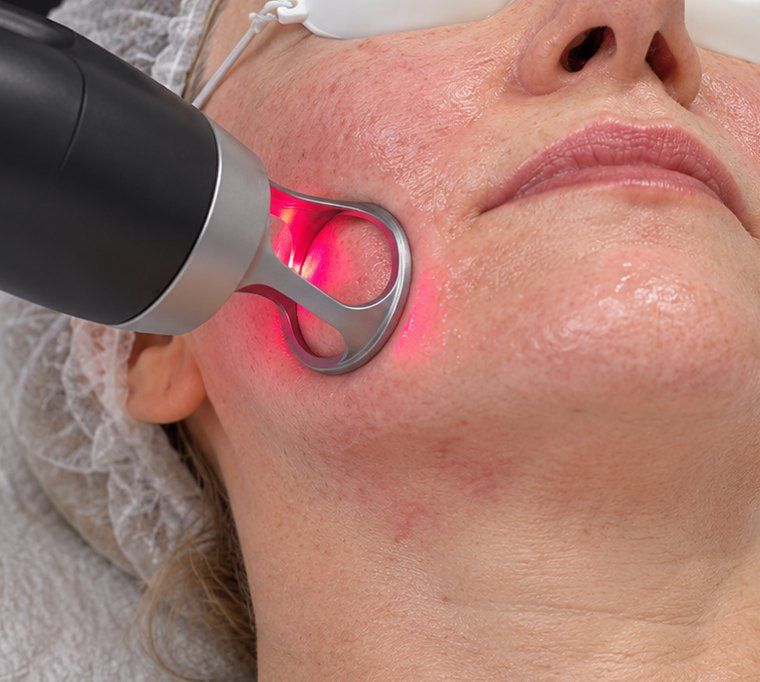 Close view of a laser handpiece on a cheek
